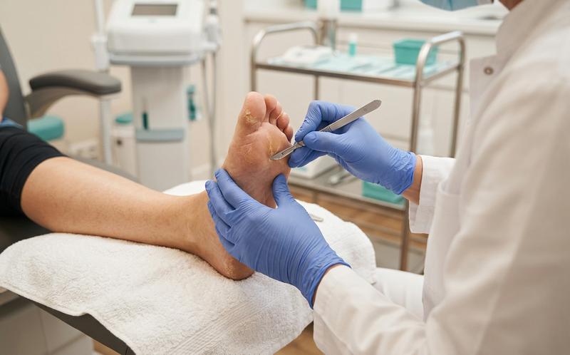 Hornhaut & Hühneraugen